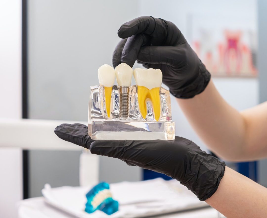 human teeth model, pointing crown of dental implant, offering advice on dental implant maintenance