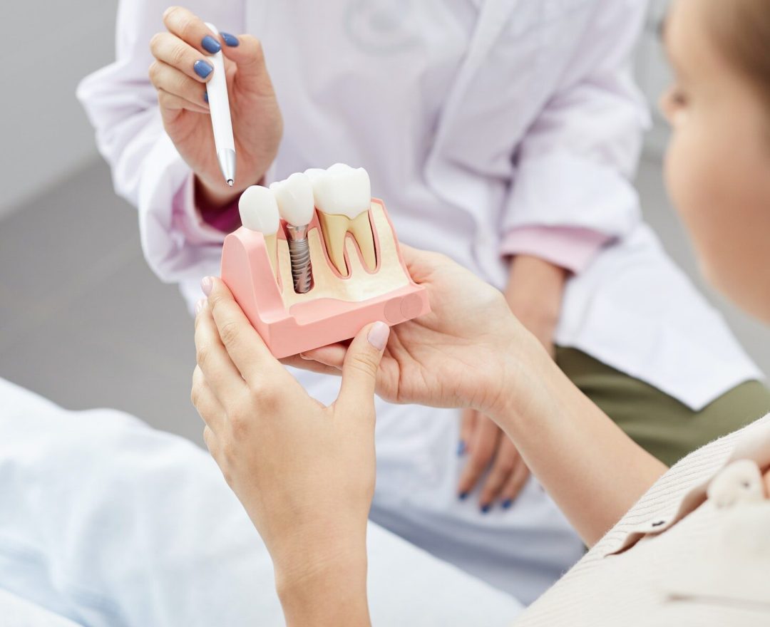 Tooth Implantation Model